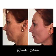 Apr 15, 2019 · perhaps more than any other trait, beards are perceived as a sign of gruff manliness. Weak Chin See Immediate Results Without Surgery