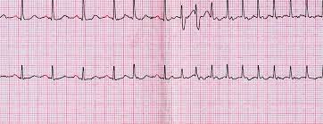 If you have experienced a heart attack, or are close with collateral circulation can also develop after a heart attack to help the heart muscle recover. Heart Rhythms What S Normal Versus Cause For Concern Johns Hopkins Medicine