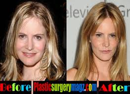 Jennifer jason leigh (jennifer leigh morrow) is an american actress. Jennifer Jason Leigh Plastic Surgery Before And After Plastic Surgery Magazine
