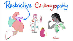 Image result for Restrictive Cardiomyopathy