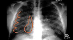 Read about the history of tuberculosis (tb), its symptoms, causes, diagnosis, treatment. Hd Cxr In Tb Em Rap