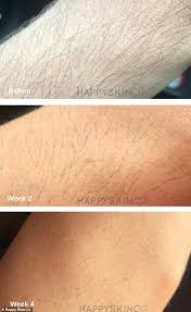The laser inhibits the hair's ability to grow without we have the most affordable laser hair removal prices and will match any competitor's price. Beauty Experts Weigh In On Whether Diy Laser Hair Removal Really Works Express Informer