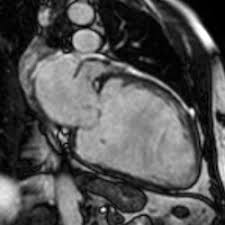 Auch bei patienten mit schrittmachern können mrt untersuchungen durchgeführt werden. Kardio Mrt
