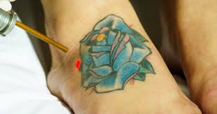 Here's why our kalamazoo, mi crew can do it best. Northern Michigan Tattoo Removal Brings Advanced Multicolored Laser Tattoo Removal To Traverse City Mi With The Astanza Trinity Astanza Laser Llc