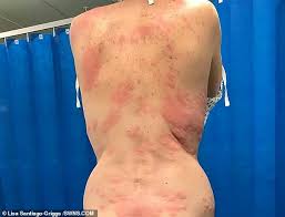 Mother Suffers An Allergic Reaction To Vaping Daily Mail Online