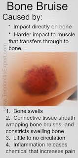 Pin On Tendonitis Info