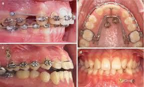 However, many dental treatments can help restore the gums around the teeth. Orthodontic Implants And Orthodontic Implant Surfaces Springerlink