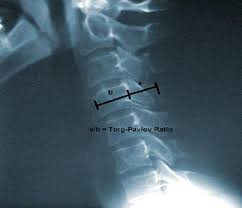 Neck Pain Rheumatology Advisor