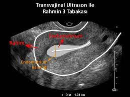 Jan 18, 2020 · rahim sarkması ultrasonda görülür mü? Rahim Duvar Kalinlasmasi Endometrial Hiperplazi Nedir
