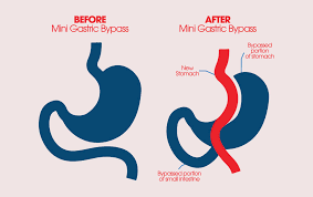 Both gastric bypass and gastric sleeve surgery lead to improvement or complete resolution of comorbid conditions such as hypertension, diabetes mellitus, sleep apnea laparoscopic gastric bypass vs. Mini Gastric Bypass Pros Cons Vida Wellness And Beauty