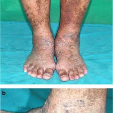 Image result for Lipodermatosclerosis