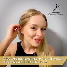 🔎🔉Female Hairline Restoration Results, 1 year post-op. This patient took  the initiative early and we were able to transplant close to 2500 grafts to  lower her overall hairline. Head to our website to ...