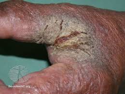 Image result for scabies norvegica
