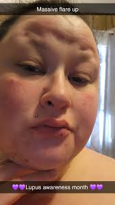 Lupus??...is it LUPUS??!?!??😳