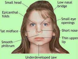 Pin On Fetal Alcohol Syndrome