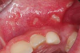 Erkrankungen Mit Beteiligung Der Mundschleimhaut Bei Kindern Teil 1 Zwp Online Das Nachrichtenportal Fur Die Dentalbranche