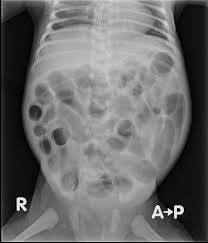 Image result for Necrotizing Enterocolitis