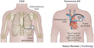 Icds are useful in preventing sudden death in patients with known, sustained ventricular tachycardia or fibrillation. Clinical Experience With Subcutaneous Implantable Cardioverter Defibrillators Nature Reviews Cardiology