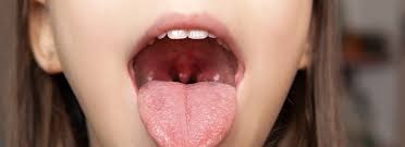 Image result for cancer of tongue