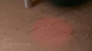 It like someone had a bat in a canister of silly string; How To Get Rid Of Hair Bumps In 5 Simple Easy Steps