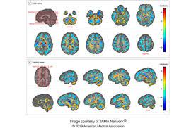 Die symptome scheinen auf den ersten blick nicht ungewöhnlich: Advanced Neuroimaging Shows Brain Matter Alterations In U S Government Personnel Who Developed Neurological Symptoms In Cuba Penn Medicine