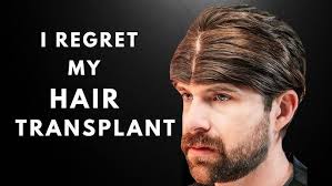 I Regret My Hair Transplant