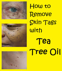 How To Remove Skin Tags With Tea Tree Oil Skin Tag Removal Living Essentials Oils Oils For Skin