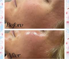 Check out this amazing before and after a treatment of PDRN ...