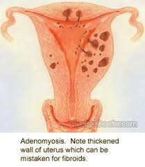 This Is Why At The Ridiculously Young Age Of Almost 33 I Am Having My Uterus Evicted Hysterectomy Scheduled For 8 5 15 Fibroids Hysterectomy Uterus