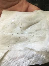 Photo Of My Hair Helpers Calabasas Ca United States These Were The Eggs And You Can See Lice As Well Lice Nits Hair Helpers Head Lice Remedy