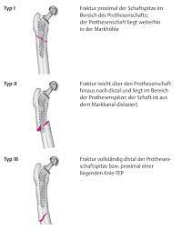 International classification of goods and services for the purposes of the registration of marks under the nice agreement. Frakturen Im Bereich Der Huftendoprot Eref Thieme
