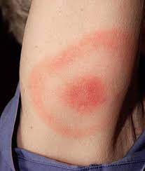Doenca De Lyme Wikipedia A Enciclopedia Livre