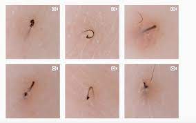 Learn what causes ingrown hair and discover expert tips for dealing with these pesky (but generally harmless) an ingrown hair forms when a hair follicle becomes trapped under the skin, causing inflammation and irritation. How To Pop An Ingrown Hair Pimple