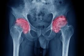 Grade de handicap (dizabilitate) încadrarea în grade de handicap se face în raport cu intensitatea deficitului functional individual si prin 1. Coxartroza ArticulaÈ›iilor È™oldului De Gradul 2 Coxartroza Artroza Soldului Ortopedia Pe InÅ£elesul Tuturor