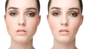 Día uno de #bichectomia y #rinoplastia todo increíble. Bichectomia Bio Bio Home Facebook