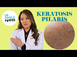 Image result for Keratosis pilaris