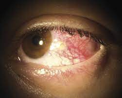 Alarmzeichen Rotes Auge