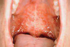 Image result for Mouth ulcers symptoms roof of the mouth