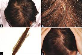 In 2020, a study found topical. P Acnes Bacteria That Causes Acne Linked To Hair Loss How To Stop It