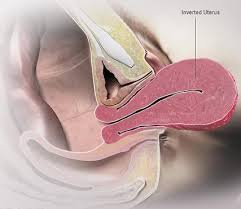 Image result for Uterine Inversion