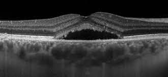Santral Seroz Retinopati Belirtileri Tedavisi Istanbul Retina Enstitusu