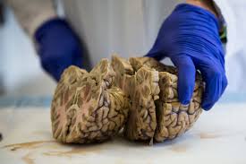 Is there something i am missing or not understanding well? On C T E And Athletes Science Remains In Its Infancy The New York Times