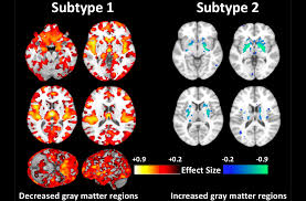 Social cognition and schizophrenia / edited by corrigan p. Researchers Discover Second Type Of Schizophrenia Penn Medicine