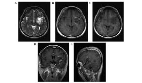 Brain or spine imaging such as magnetic resonance imaging (mri) can often identify areas of demyelination. Cerebral Tumefactive Demyelinating Lesions
