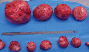Maybe you would like to learn more about one of these? Klinik Avicenna Fibroid Bahaya Ke Banyak Sangat Facebook