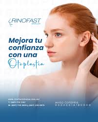 Paciente Mariela Quintero con Rinoplastia,sin cicatriz visible con  Anestesia Local. (Cirugía funcional y Estética, Rápida recuperación)  Técnica creada por el (Dr. Hector Manuel Marin Mendez ) Contáctanos Tel:  (667) 7151142