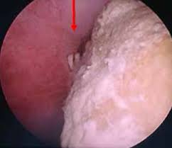 Johor baru, nov 19 — hospital sultanah aminah (hsa) here has formed a special a google screenshot of hospital sultanah aminah in johor baru. Intrauterine Contraceptive Device Embedded In Bladder Wall With Calculus Formation Removed Successfully With Open Surgery Abstract Europe Pmc