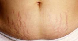 Was Sind Das Fur Rote Striche Am Bauch Junge Gewicht