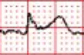 Cardiac Cath Lab Activation for Subtle Acute Inferior STEMI