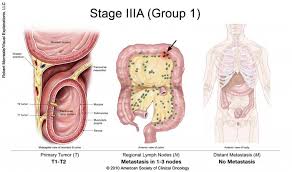 colorectal cancer stages cancer net